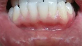 Gums and teeth