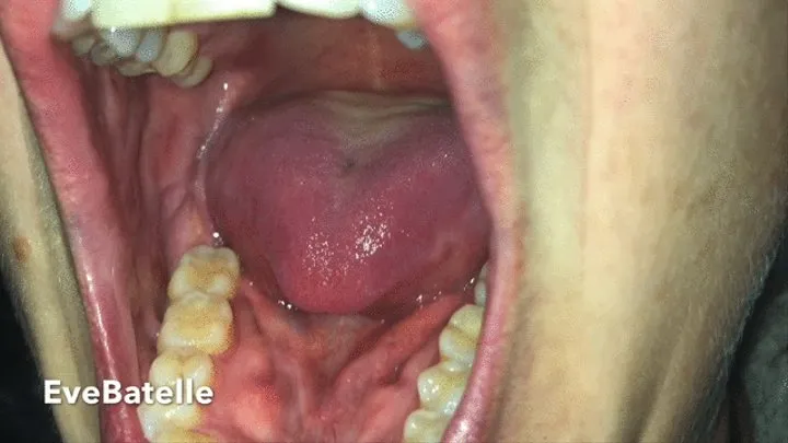 Lip Pulling Teeth And Gum Exam