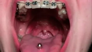 VIBRATING UVULA DURING COUGHING (U)