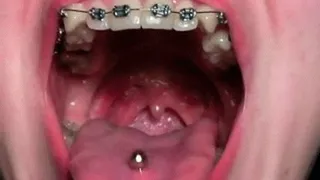 VIBRATING UVULA DURING COUGHING (B)