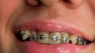 SEXY BRACKETS CLOSE UP