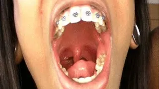 Braces Vore Swallowed Alive By Girl With Braces 1 HD 720p