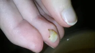 Aftermath of a Broken Molar