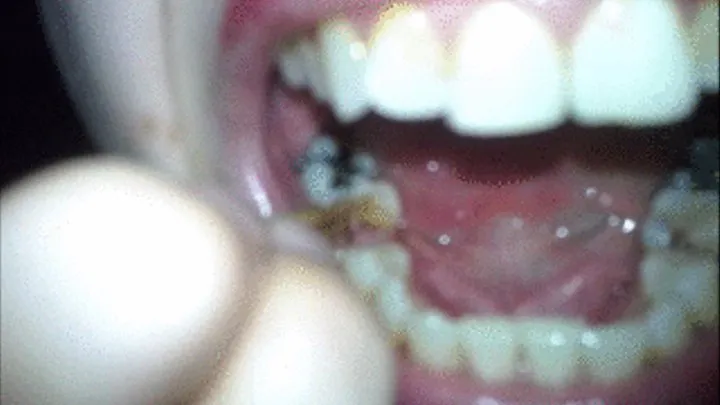 Cracked Tooth Manipulation