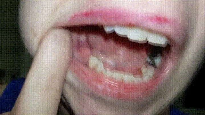 Canker Sore :: 31 Socket