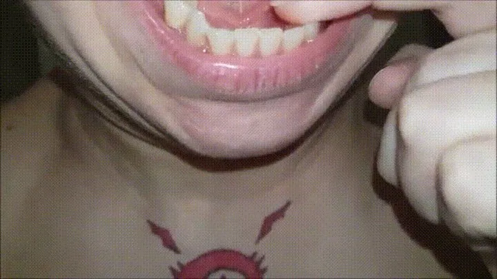 Canker sore Inside Gum Line