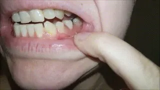 Showing Off New Partial Denture