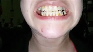 Kernels Stuck-in Teeth