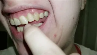 Plaque Covered Teeth