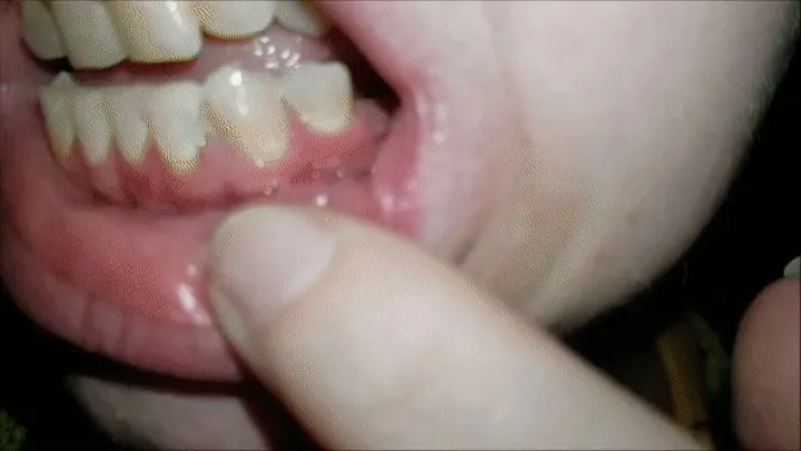 Two Fillings & Dirty Teeth