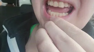 Front Tooth Filled But Somethings Not Right