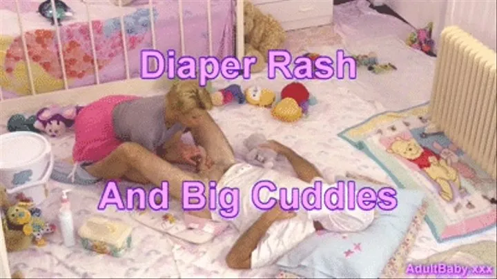 Diaper Rash And Big Cuddles