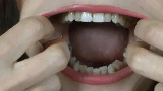 A lot of cavities ( TEETH )