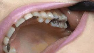 fillings, fillings, fillings... ( MOUTH FETISH )