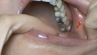 Giò rotten teeth.