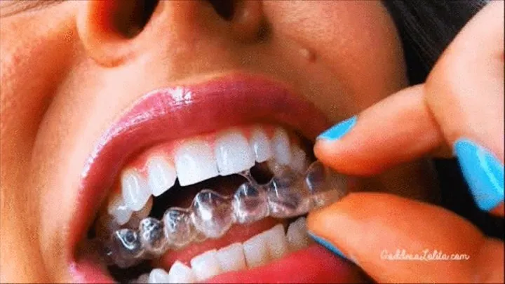 Invisalign Fetish