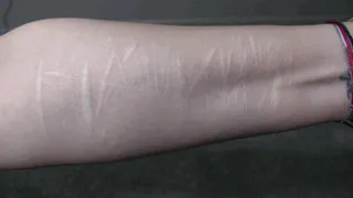 Extreme Arm Scars