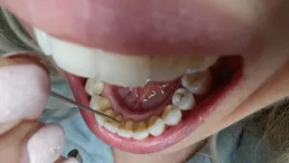 Scraping teeth - request