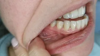 Custom, teeth scraping