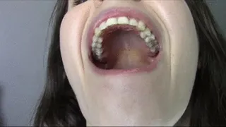 Temporary Tooth