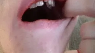 Christinas Teeth Extraction
