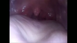 Sore throatand tonsilitis (mouth fetish)