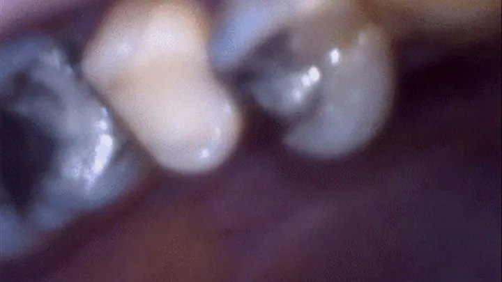 Teeth fillings (extreme close-ups)