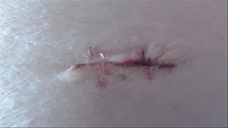 Fresh scars on my belly (belly fetish)