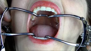 Dental Exam Gone Bad Custom