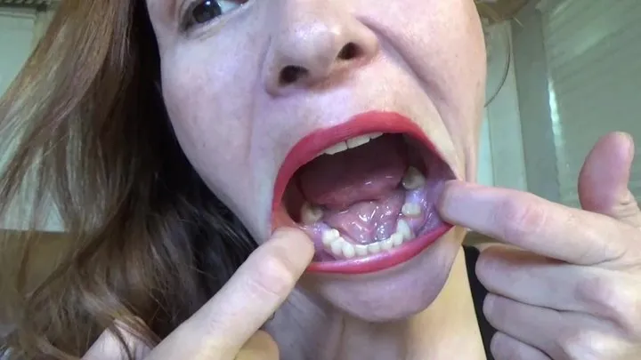 Sarah's New Fillings