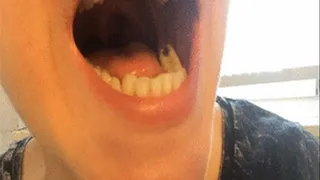 Tongue And Tongue Veins 2°