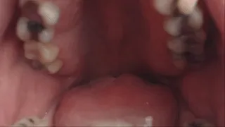 My Full Dental Exam Updated Mouth Fetish