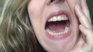 Showing Off Mouth After Braces Removal