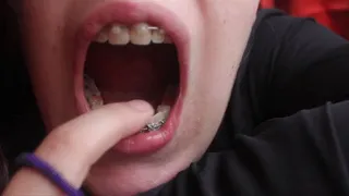 Lana's Full Mouth & Teeth Inspection with Braces