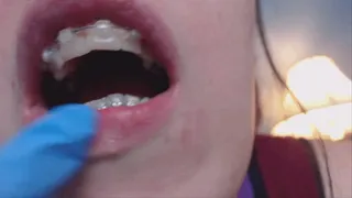 Cleaning my Mouth & Braces Dental Video