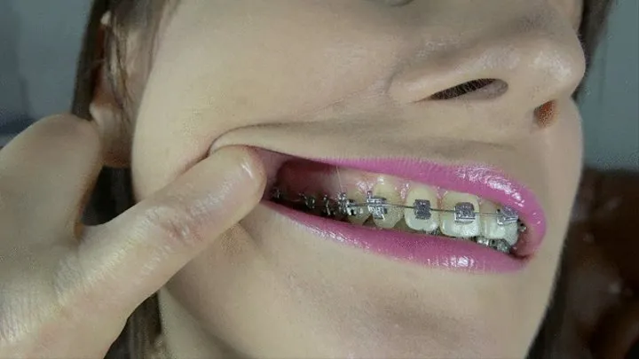 Weronika - 2 Weeks Braces - Extreme Close-Ups