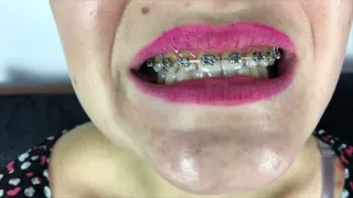 Zuzana - Braces Extreme Close - Ups