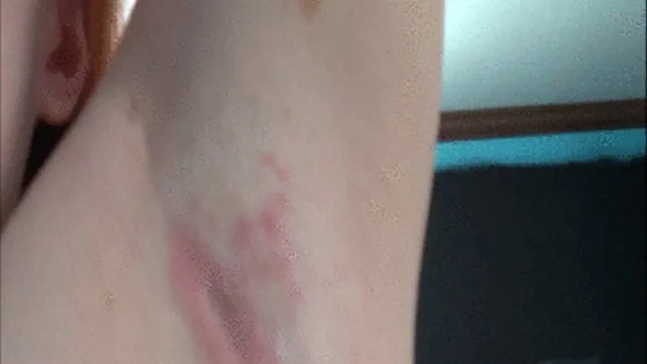 WIERD RASH ON ARMPIT WIERD