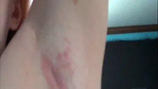 WIERD RASH ON ARMPIT WIERD