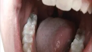 Mouth Tour: Showing My Cavities