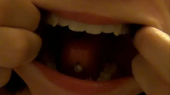 Gums Lip Veins In My Mouth