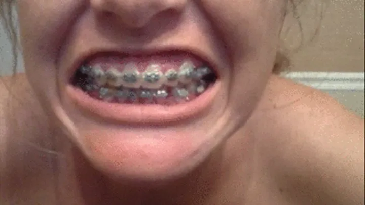 braces