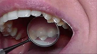 dental mirror for examination of the oral cavity