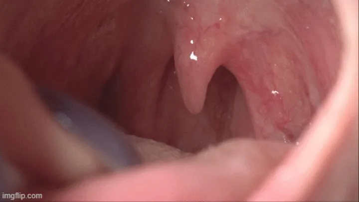 swollen throat