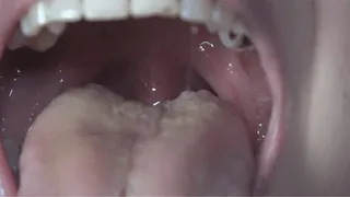 cavity