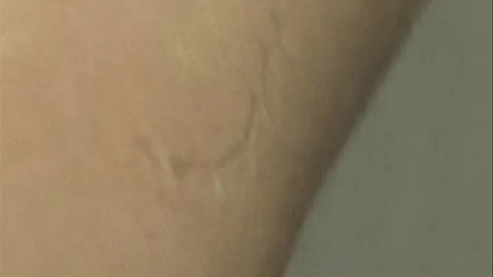 My bite mark