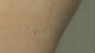 My bite mark