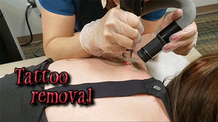 Tattoo removal