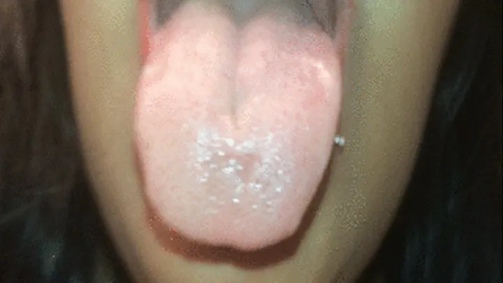 Extremely swollen tonsils