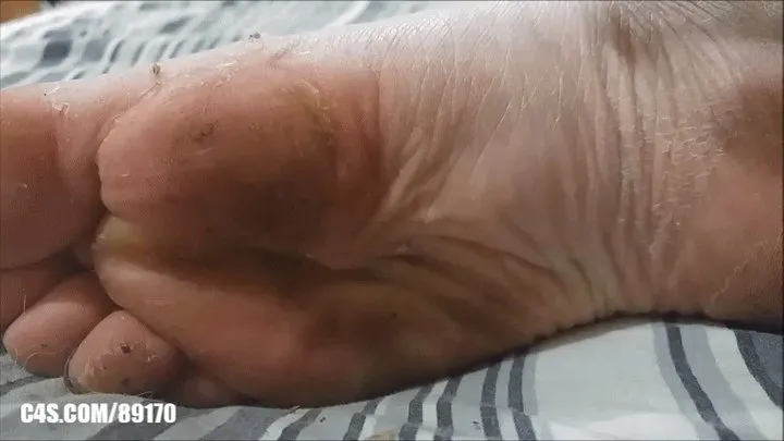 Nasty Peeling Feet!